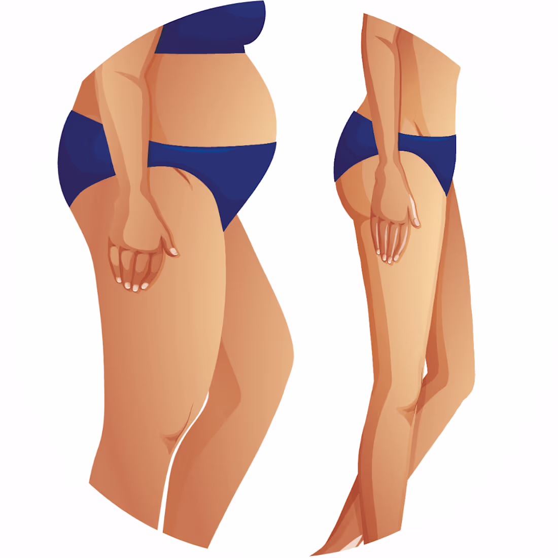 Cover image for What is Liposuction