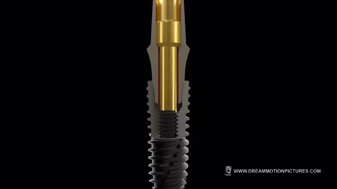 Cover image for Innovative Dental Implant Material Animation