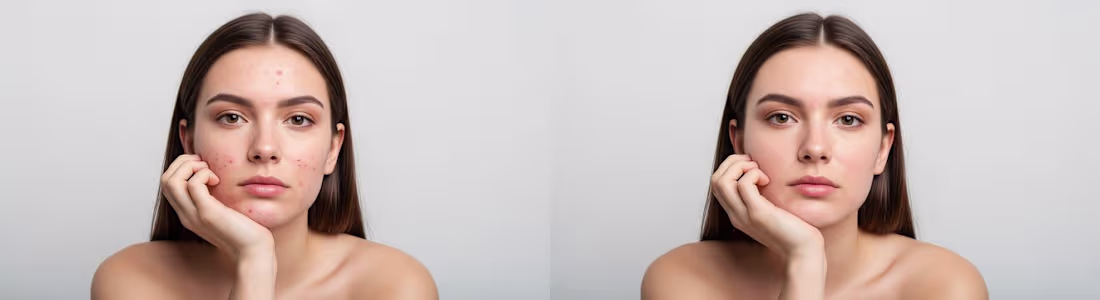 Cover image for Blemish Removal