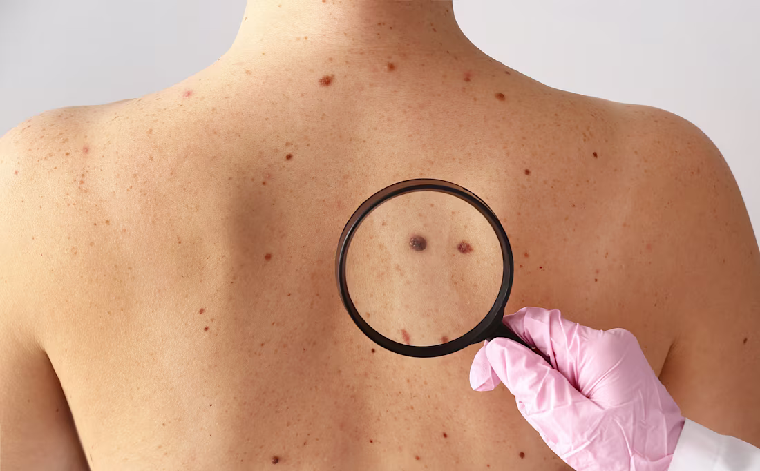 Cover image for Oral Vitamin D Supplementation May Lower Melanoma Risk