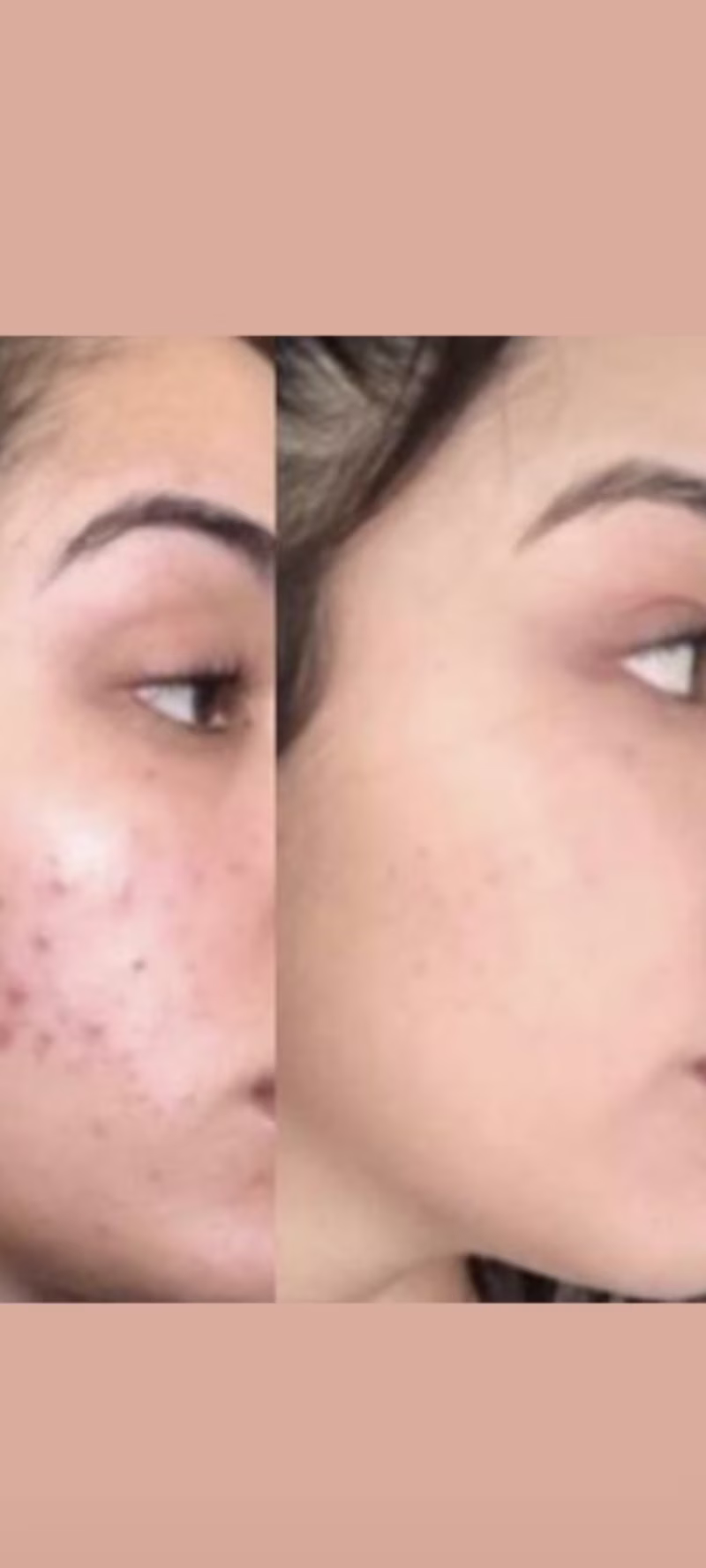 Cover image for Product description: Acne treatment cream.