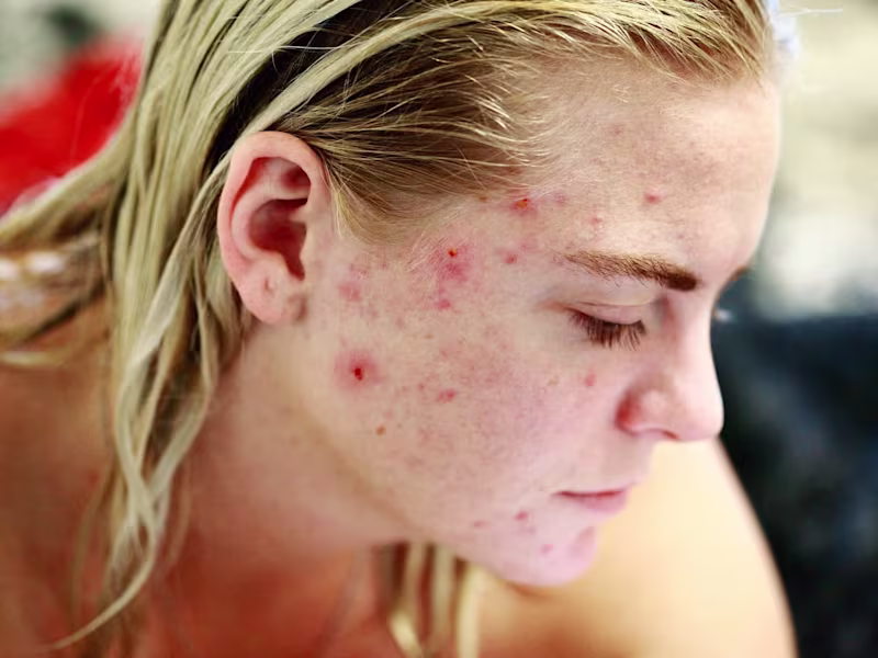 Cover image for How to get clear skin in 2023 
