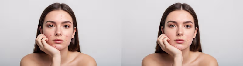 Cover image for Blemish Removal / Portrait Retouching