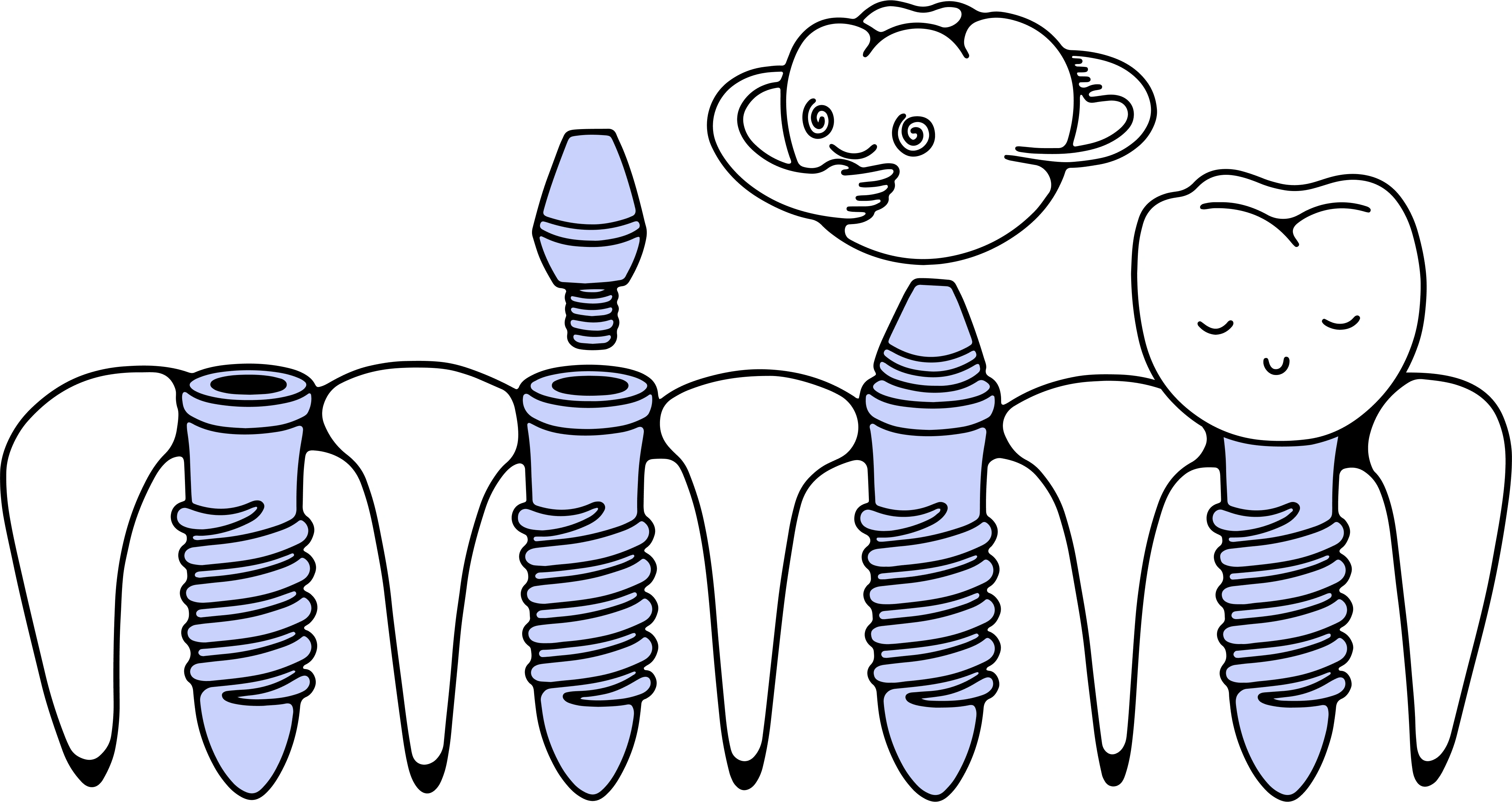 "Dental Implants"