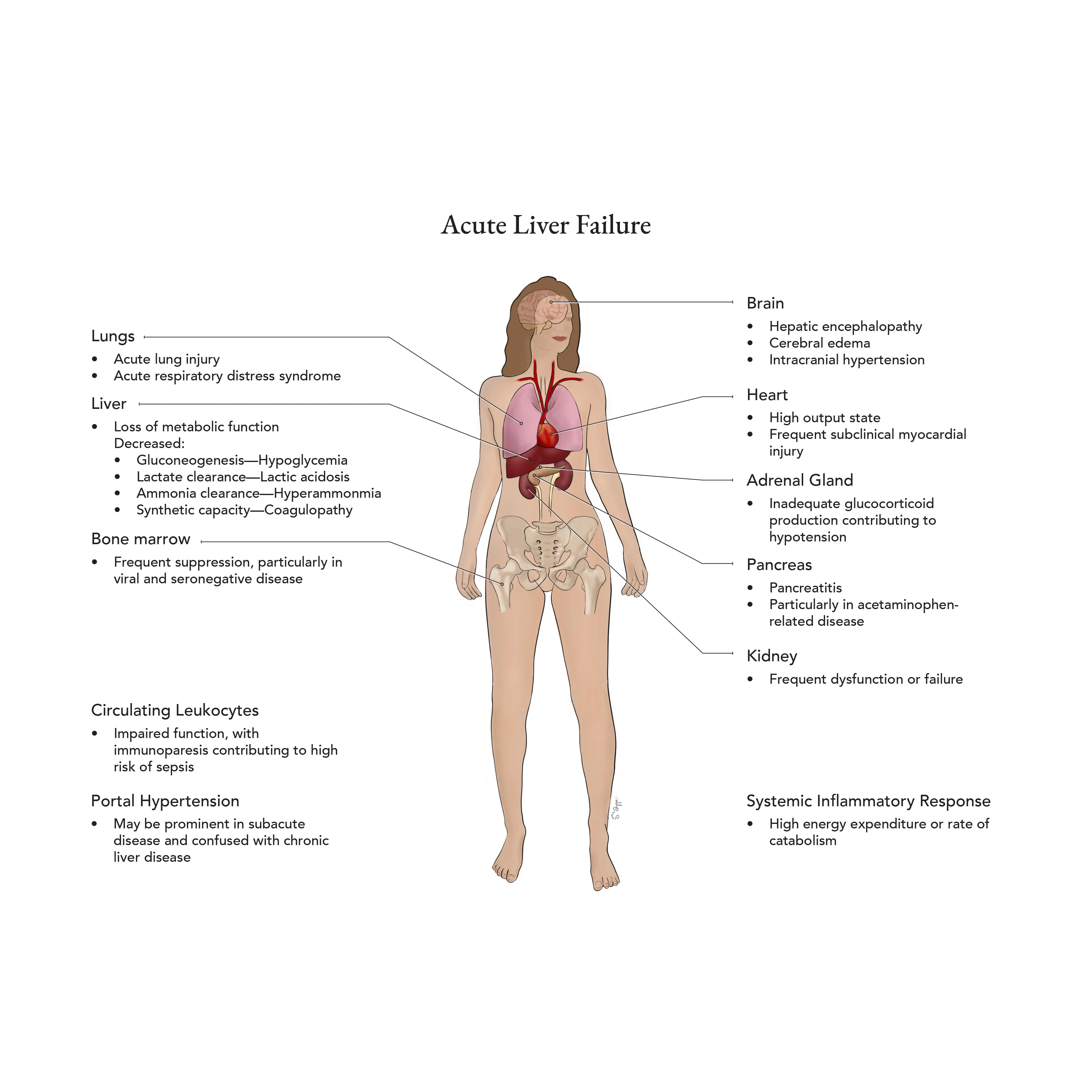 Acute Liver Failure illustration - This illustration was for an anesthesiologist working on liver transplants. He wanted one image to show all of the symptoms of acute liver failure after a transplant. 