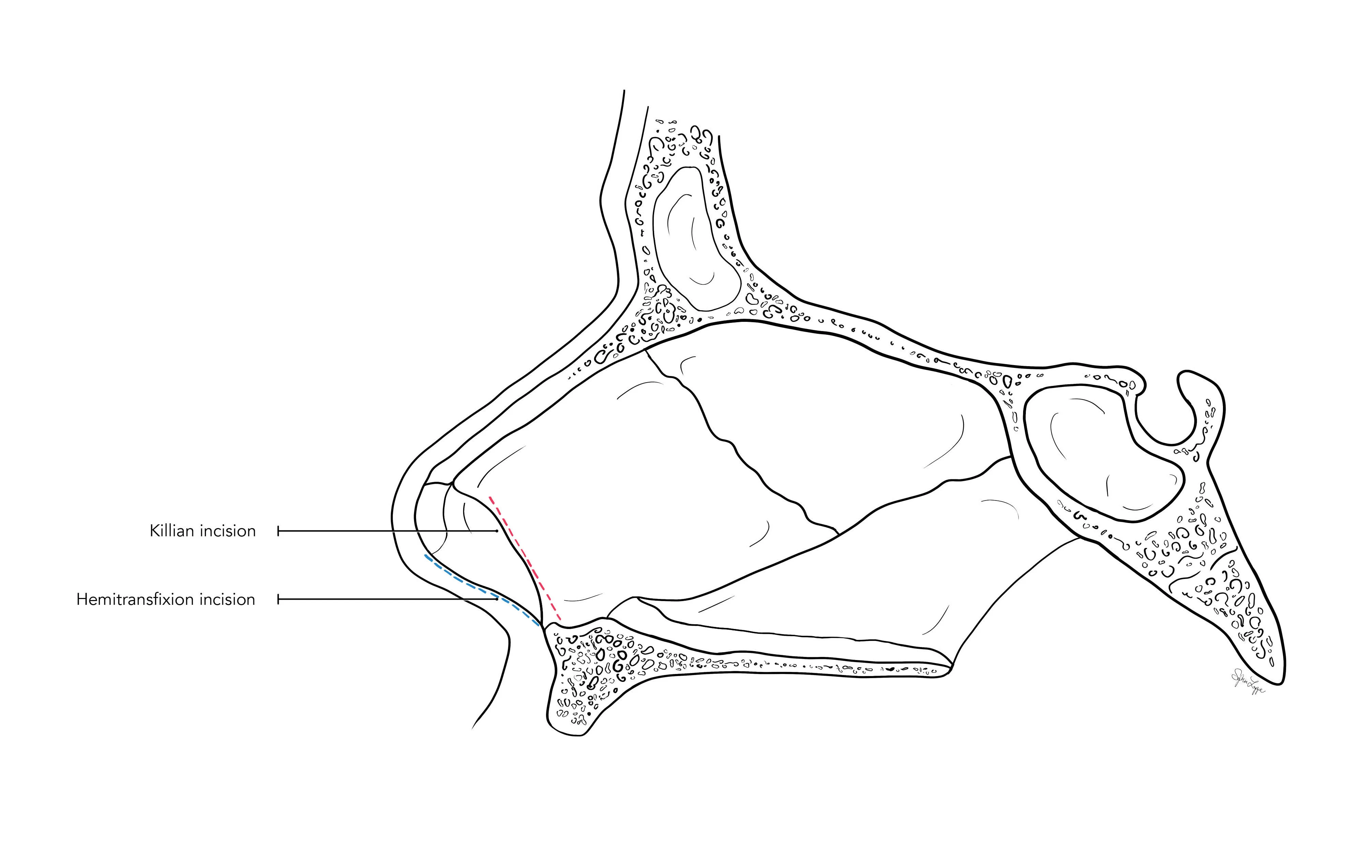 Nasal Surgery - The goal of this project was to show the two separate techniques for nasal surgery. 