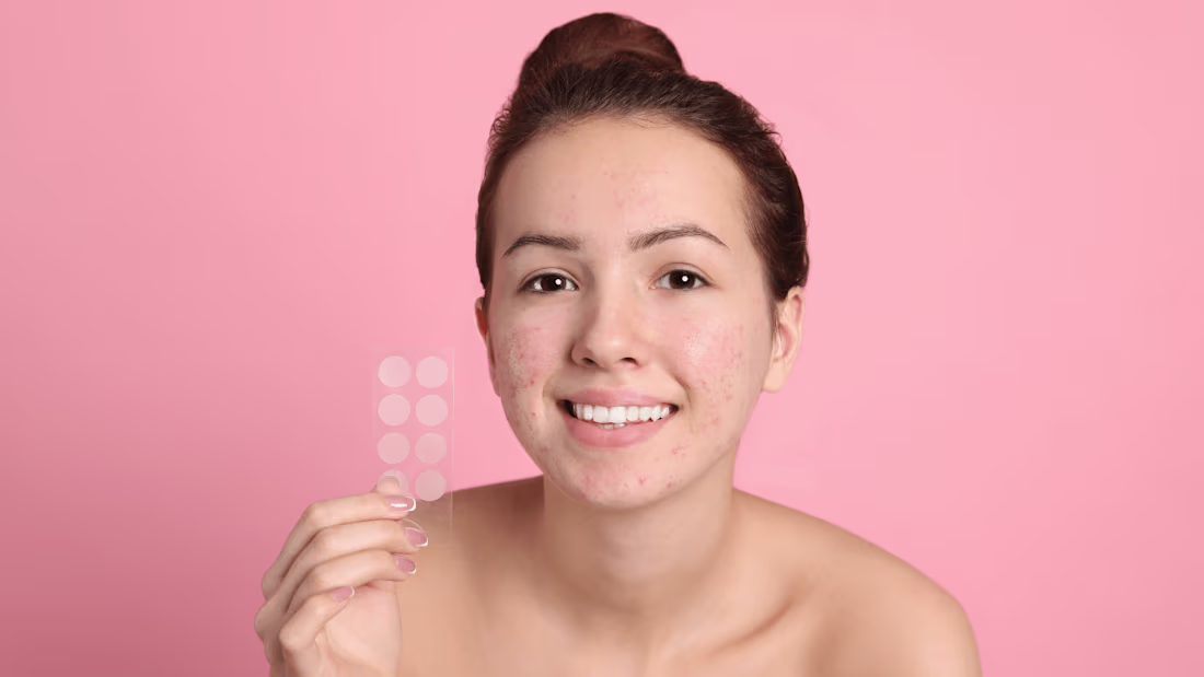 Cover image for 5 Reasons You Still Have Pesky Persistent Acne