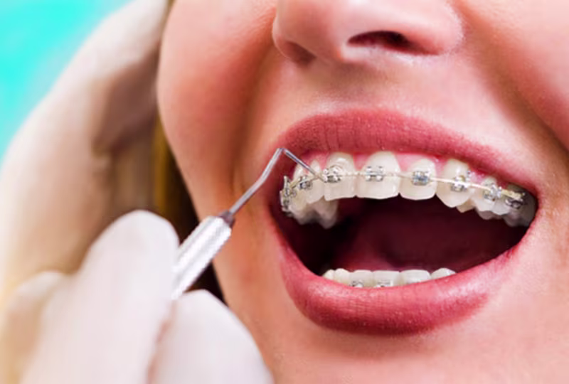 Cover image for SEO Blog Writing for Orthodontist