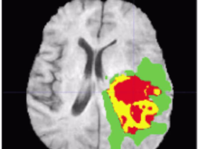 Cover image for Brain Tumor Segmentation Using U-Nets