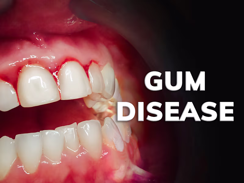 Cover image for Gum Disease Video Sales Letter