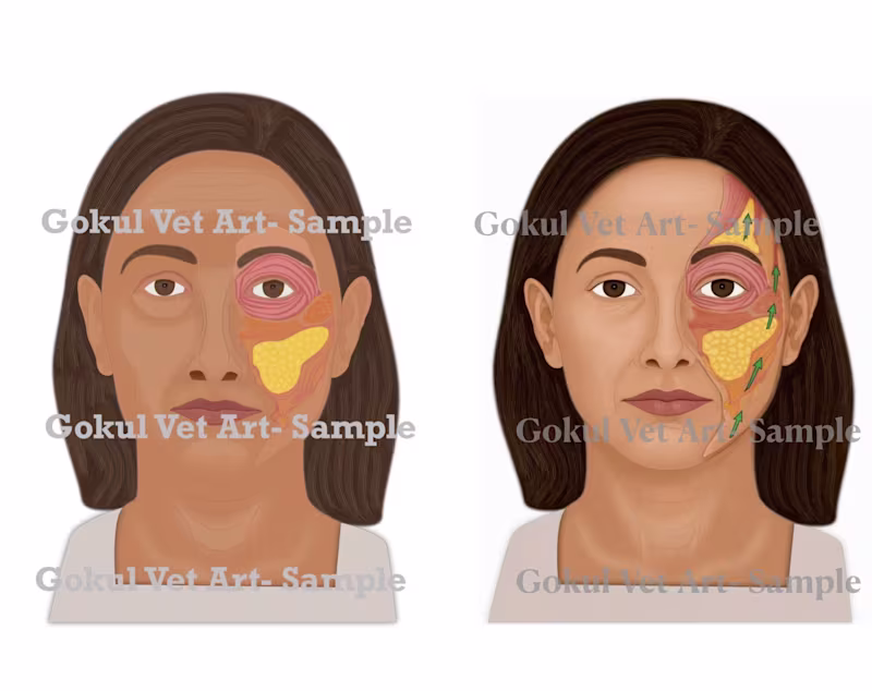 Cover image for Mid-Face Lift — Before &