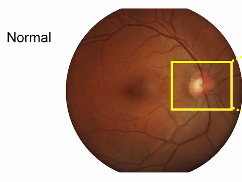 Cover image for Glaucoma detection