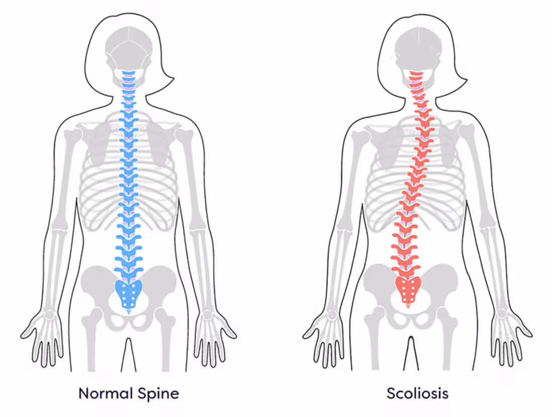 Cover image for Title: Scoliosis awareness 3000% ROAS Client: SKMC Hospital ...