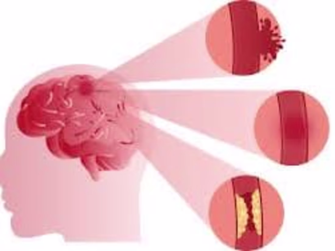 Cover image for STROKE - MosiPhysio