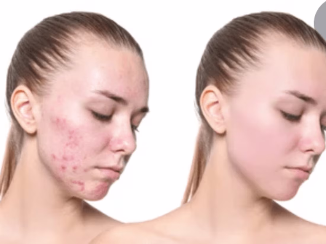 Cover image for End Acne now and regain your Beautiful Cute Face.
