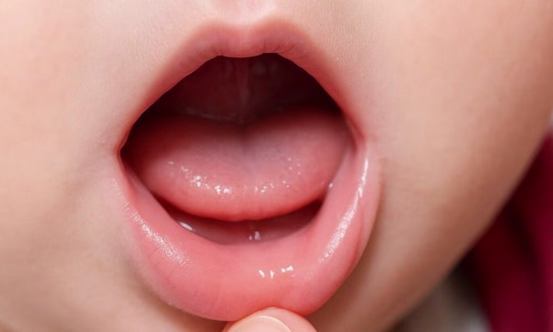 Cover image for Understanding Lip Tie in Infants and toddlers 