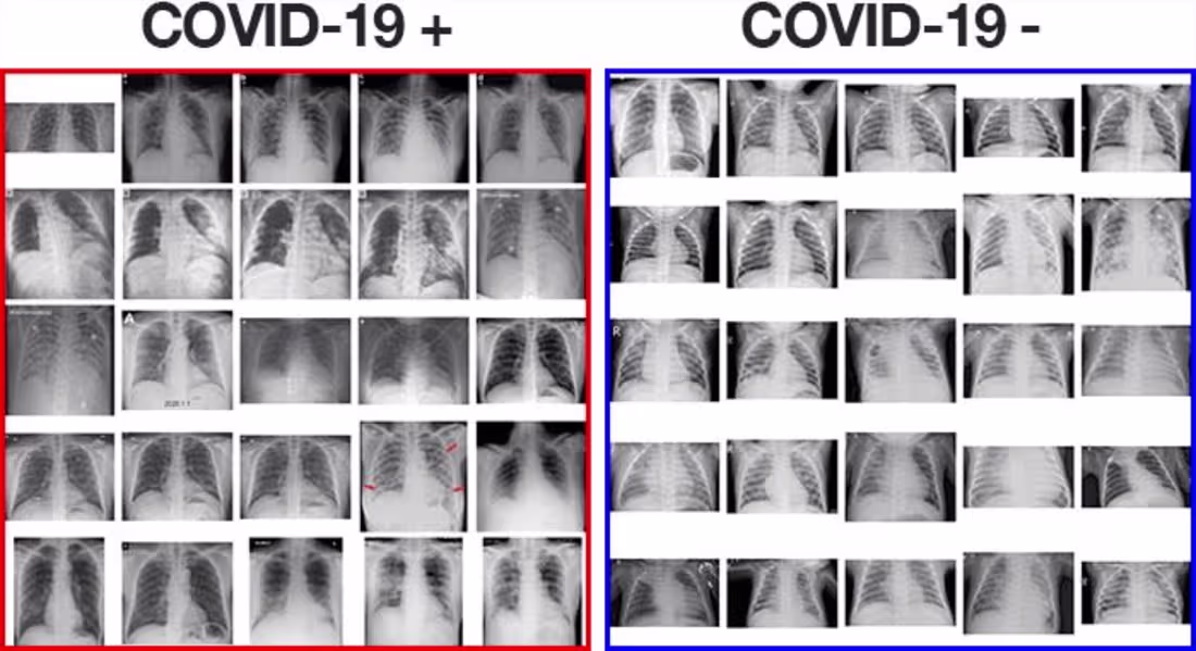 Cover image for AI-Powered COVID-19 Detection via Chest X-Rays