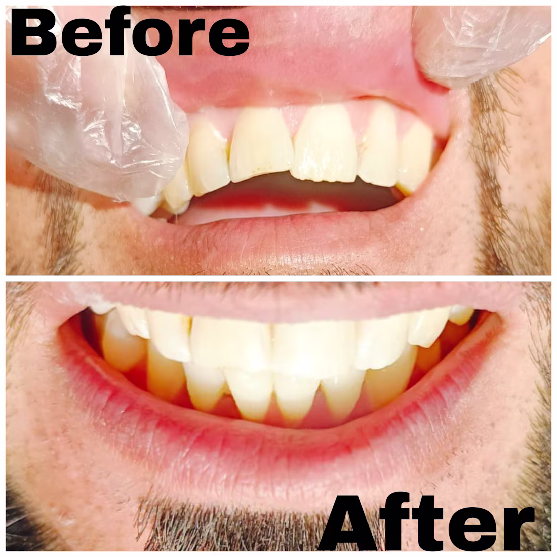 Cover image for Dental Composite Bonding: Repairing a