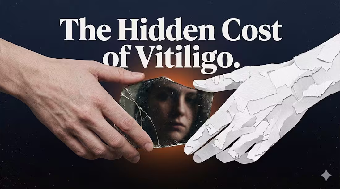 Cover image for Vitiligo, Anxiety, and the Hidden