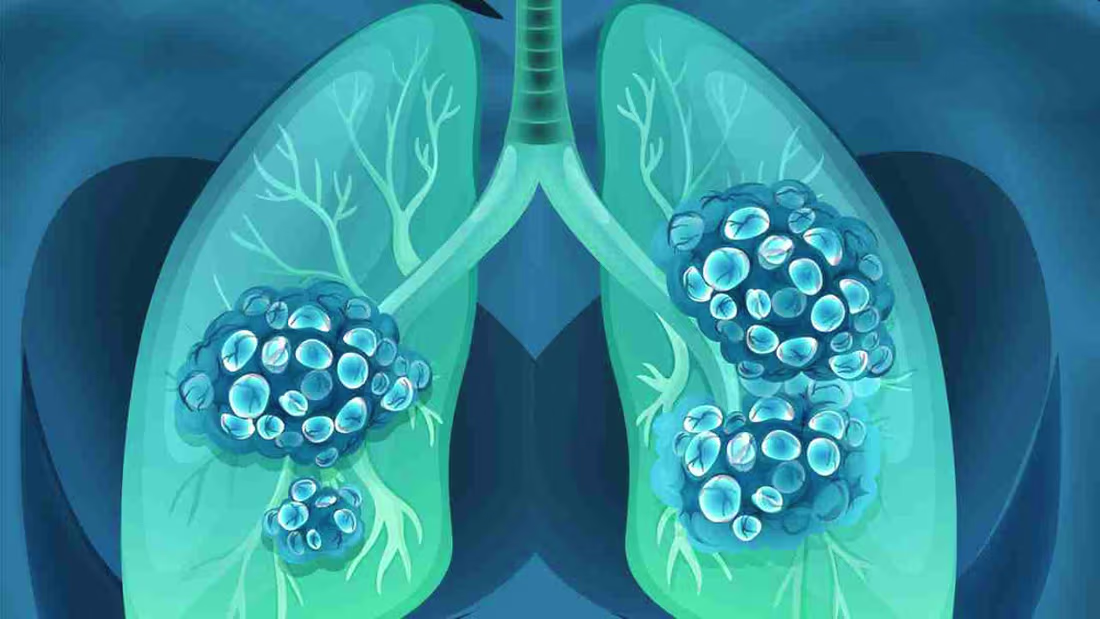 Cover image for Overcoming the challenges of low PD-L1 lung cancer: The latest …