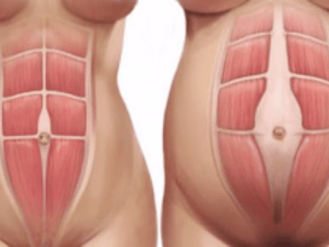 Cover image for Abdominal Separation Blog