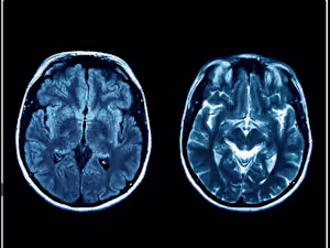 What Is Joubert Syndrome?