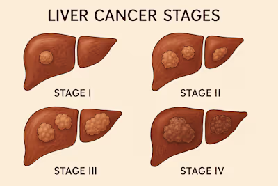 Understanding Liver Cancer Stages and Treatment