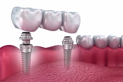 How long can it take to adjust to dental implants? | Excel Dent…