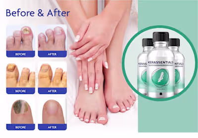 Kerassentials Oil: Natural Solution for Nail and Skin Health