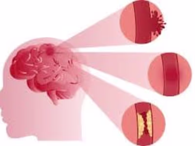 STROKE - MosiPhysio