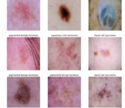 Skin Cancer Classification