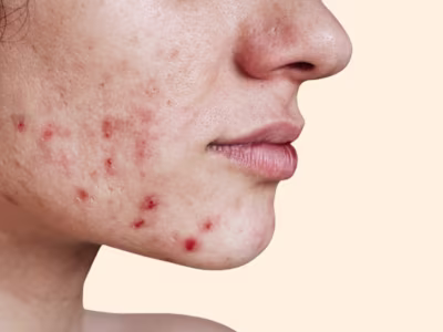 5 Unexpected Reasons Why Your Skin Is Breaking Out