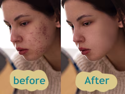 blemishes and acne (rosacea) removal | skin retouching