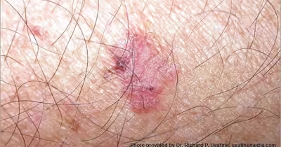 The Interstitium: a possible cause of cancer spread