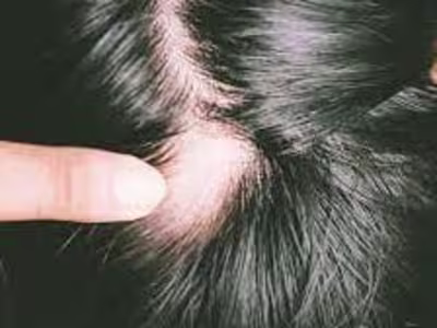 Alopecia areata