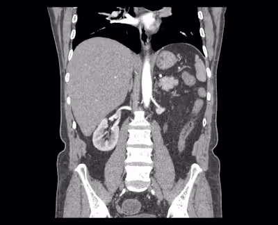 End-to-end pipeline for kidney disease classification 
