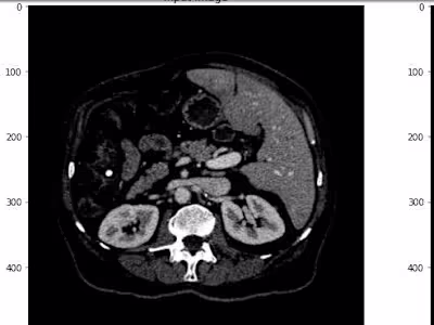 Advanced U-Net Model for Liver and Liver Tumor Identification