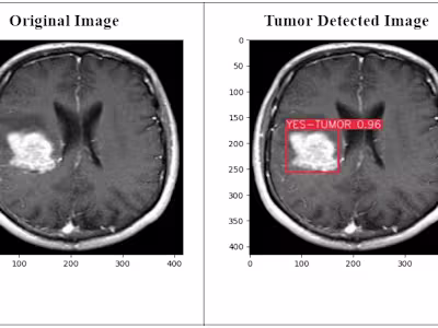 Advanced Brain Tumor Detection & Segmentation