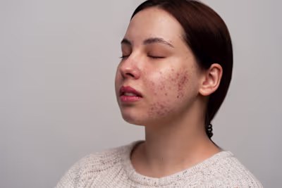 Accutane | How It Works | What To Expect During Treatment