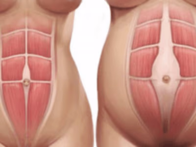 Abdominal Separation Blog