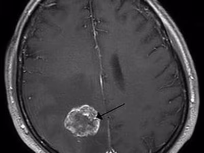 BRAIN TUMOR - MosiPhysio