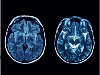 What Is Joubert Syndrome?