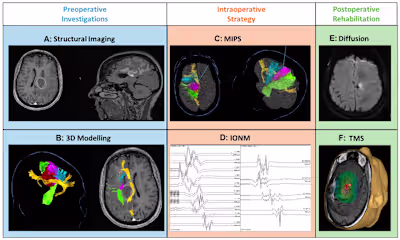 3D MultiModal MRI Segmentation