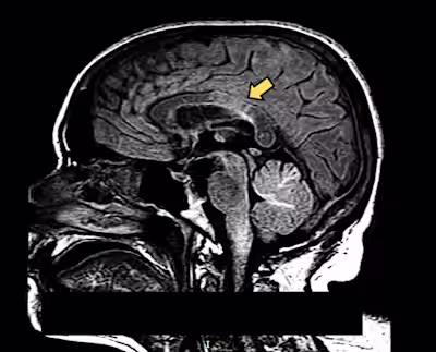 Death following rapidly progressive demyelinating disorder in a…