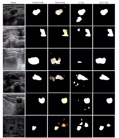 Breast-Tumor-Segmentation-in-Ultrasound-Images