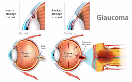 Glaucoma Empowerment Guide: Symptoms, Causes, and Treatment
