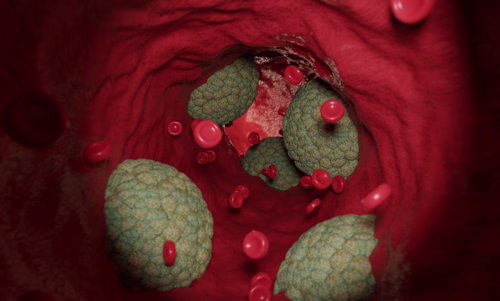 Taking Statins to Reduce Cardiovascular Disease in T2 Diabetics