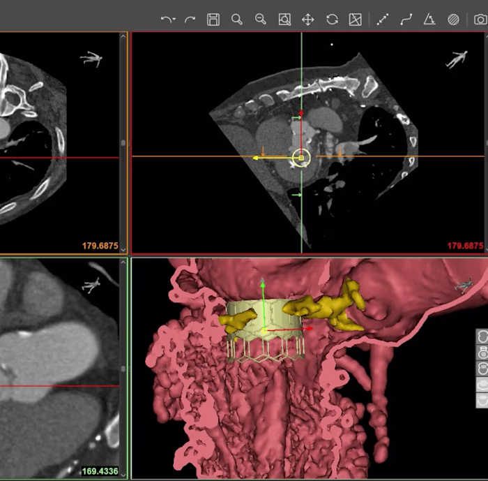 Mitral Valve Planner