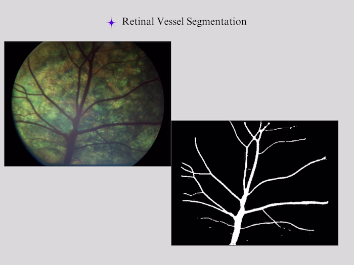 Retinal Vessel Identification and Disease Detection
