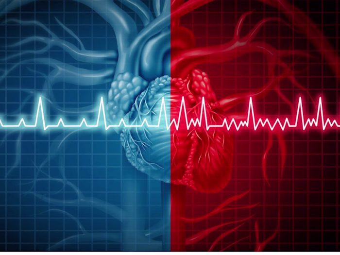 Silent Myocardial Infarction in Diabetic Elderly Patient-